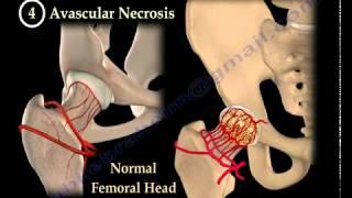 HIP PAIN , hip joints, orthopedics