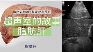 脂肪肝---超声室的故事【Ultrasound Room】Diagnosing Fatty Liver on Ultrasound