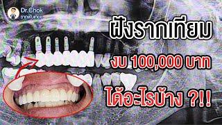 ฝังรากฟันเทียมฟันหน้า งบ 100,000 บาท สวยขนาดไหน คลิปนี้มีคำตอบ ?!! l คลายปัญหารากฟันเทียมกับหมอโชค