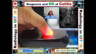 Colitis and thumbprinting (Radiology in GIT- 9)