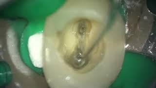 Managing sclerosed canals UR4