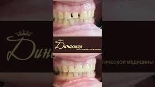 #dent #hollywood #hollywoodsmile #lumineers #smile #виниры #vineers #голливудскаяулыбка #люминиры