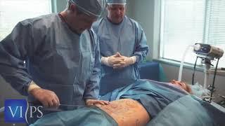 Renuvion (J-Plasma) Procedure | Virginia Institute of Plastic Surgery | Plastic Surgeon Dr. Sundin