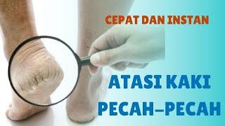 Telapak Kaki Pecah-Pecah? Cara Alami Ini Bisa Jadi Solusi!