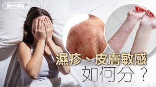 濕疹、皮膚敏感如何分？