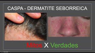 CASPA - DERMATITE SEBORREICA: Mitos e Verdades | Com Luiz Gameiro, dermatologista