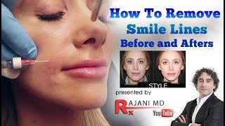 Smile Line Filler and Prevention-Before and After