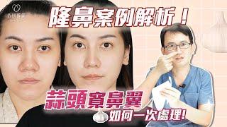 如何設計專屬隆鼻？縮鼻翼疤痕明顯？直接放大公開！一次改善蒜頭鼻、鼻翼寬、鼻基底（貴族手術）｜依心唯美 謝東穎醫師