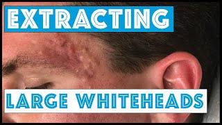 Acne Vulgaris and Extracting large Whiteheads - Part 1