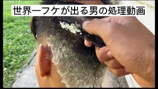 世界一フケ?が出る男のディープクリーニング動画　dandruff video treatment