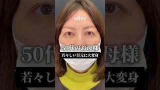 50代のお母様。美容整形で仰天若返り‼️全切開二重術×眼瞼下垂×裏ハムラ法(クマ取り)#富山 #美容整形 #二重整形 #クマ取り #眼瞼下垂 #若返り #アンチエイジング #北陸