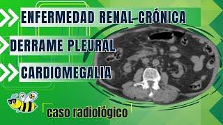 Enfermedad Renal Crónica, Cardiomegalia, Derrame Pleural...