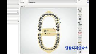 3shape 덴탈시스템DentalSystem 3oxz파일 불러와 디자인하는 방법/How to Call up and Design DentalSystem 3oxz Files