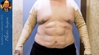 HE NEEDED ME‼️VaserLipo Gynceomastia Surgery with Skin Tightening  By Dr. Lebowitz, Long Island NY