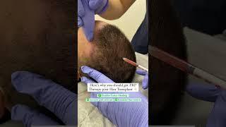 PRP Treatment | Post Hair Transplant Technique #shorts #shortsfeed Medlinks