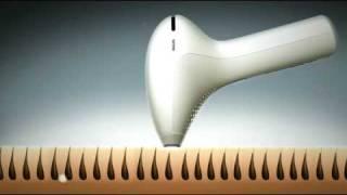 Philips Lumea: Dr. Narurkar explains (6)