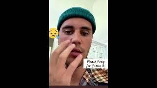 PRAY FOR JUSTIN BEIBER | FACE PARALYSIS | J3TV EPS. 00008