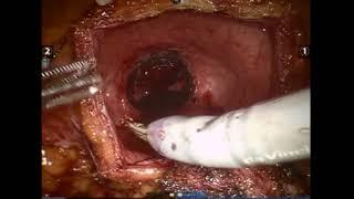 Core Videos (2017): Robotic Assisted Laparoscopic Suprapubic Simple Prostatectomy Step by Step