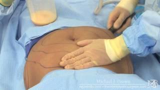 Liposuction of a woman's abdomen