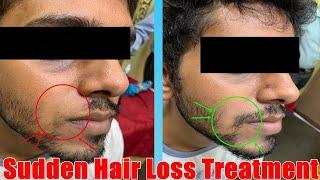 Sudden Patchy Hair Loss(Alopecia Areata)|Treatment by Intralesional steroid injection