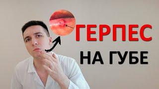 Герпес (простуда) на губе. Как быстро вылечить? Чем мазать?