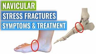 Navicular Stress Fracture: Symptoms & Treatment