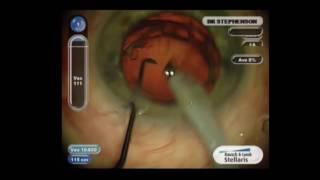 Femtosecond Laser Assisted Cataract Surgery Technique