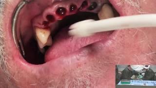 Immediate Ceramic Dental Implants in the Anterior Region