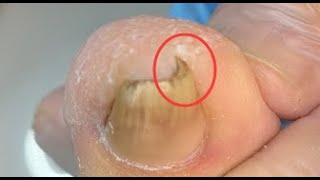 Step by step how to remove ingrown toenail