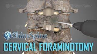 Cervical Foraminotomy