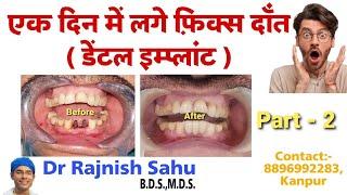 Fixed Teeth Within 1day | Part - 2 |Basal Implants | Dental Implants |@rajnishsahu82