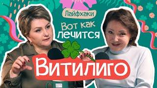 Витилиго лечится| В гостях Алия Айдарбековна врач-дерматолог | Анна Счастье