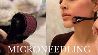 MICRONEEDLING AT HOME | How I Healed My Post Acne Scars Quickly