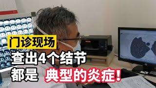 查出4个肺结节很惊慌？医生：别担心，你这都是典型的炎症