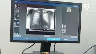 Digital X-ray CR12 agfa! how to take x-ray chest pav, cervical spine, LS spine,e.t.c