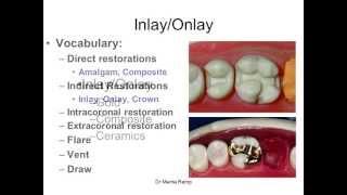 Introduction to inlays/onlays