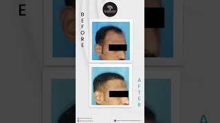 Successful Hair Transplant Results | Dr. Rashmi Aderao Skin, Hair & Laser Clinic Pune