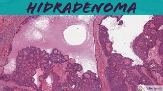 Nodular Hidradenoma (Acrospiroma): 5-Minute Pathology Pearls