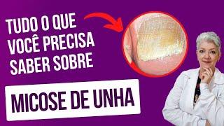 MICOSE DE UNHA O que é, Prevenção e Como Tratar