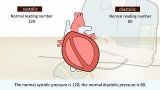 High blood pressure - What is it?