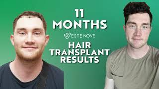 Hair Transplant Results Month by Month Turkey