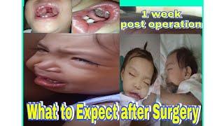 What to Expect after Cleft Palate Surgery (Palatoplasty)/ 1 week post operation