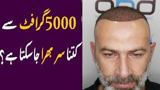 Hair transplant results in pakistan | Cost Of Hair Transplant In Pakistan | dr zunair munir