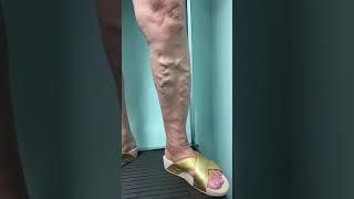 Treatment of LARGE Varicose Veins