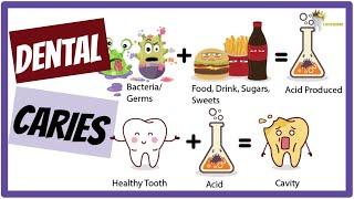 DENTAL CARIES- Etiology, Keyes Jordan diagram, Stephan's Curve SIMPLIFIED!