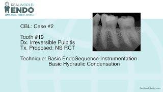 CBL #2: Basic Molar Root Canal Therapy #19 by RealWorldEndo