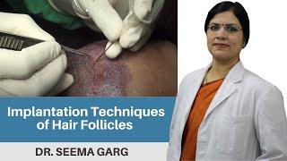 Implantation Techniques of Hair Follicles | Dr. Seema Garg