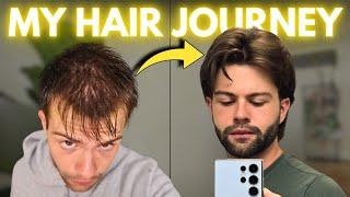 How I Stopped Hair Loss at 20: Month-by-Month Results | AL GARRIDO