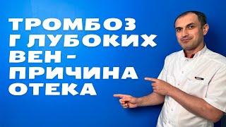 Как заподозрить тромбоз глубоких вен. Флеболог Москва.