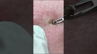 FINALLY! A DPOW for Dr Pimple Popper